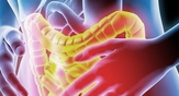 Colorectal cancer Image