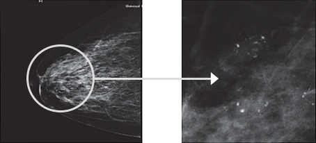 Diagnostic image of microcalcification of early signs of breast cancer