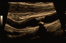 Carotid plaque Image