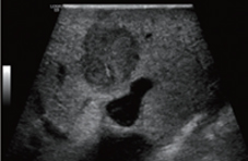 Liver lesion procedure Image