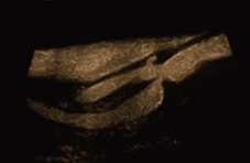 Carotid artery stenosis Image